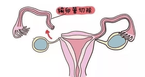 双侧输卵管切除可以做试管吗，泰国第三代试管婴儿的费用，做泰国试管婴儿多少钱