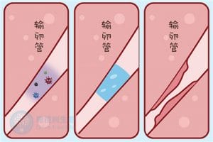 输卵管积水不孕，试管婴儿助您好孕——探索试管婴儿的费用之谜